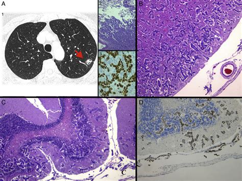 Unusual Progressive Neurological Syndrome In Epidermal Growth Factor Receptor Mutated Lung