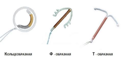 Как определить спираль у женщин - Информация, которая удивляет