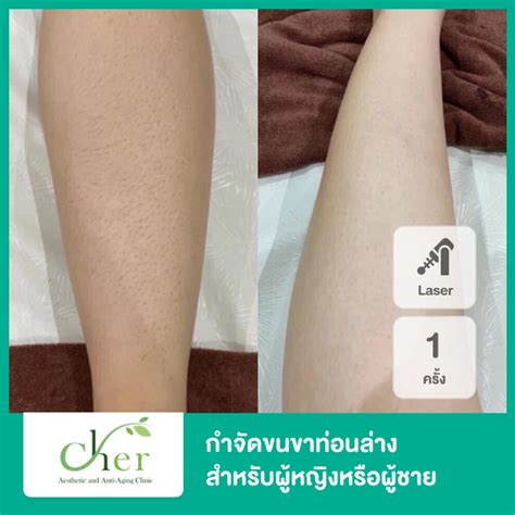 กำจัดขนขาท่อนล่าง ด้วย Diode Laser 1 ครั้ง สำหรับผู้หญิงหรือผู้ชาย ที่