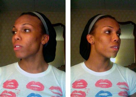 Dr Chettawut Sex Reassignment And Facial Feminization Surgery Center Facial Feminization