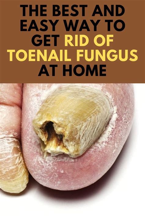 Toenail Fungus Remedies, Toenail Fungus Treatment, Fungal Nail, 2 Ingredient Recipes, Types Of ...