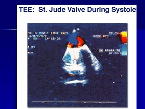 Prosthetic Heart Valves Ppt