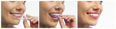 Invisalign For Adults Epic Dental Serving Norwood And Walpole