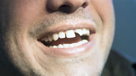 Broken Teeth Adelaide Dental