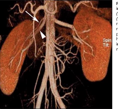 Figure 8 From Ct Angiography Of The Renal Arteries And Veins Normal