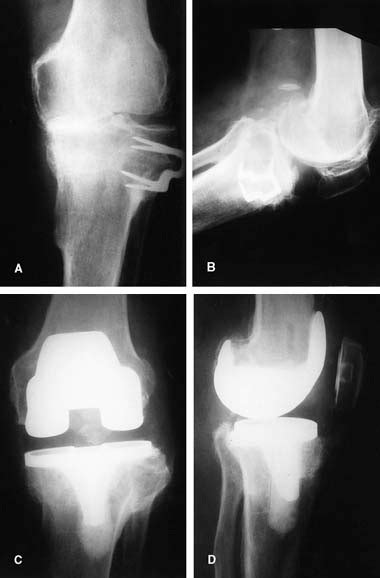 Total Knee Arthroplasty After High Tibial Osteotomy The Journal Of