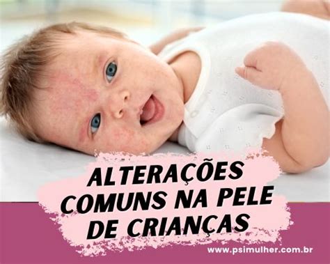 Problemas de pele comuns em bebês e como tratar Psi Mulher