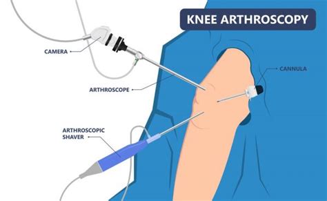 Arthroscopy Keyhole Surgery Oxford Ortophaedics Clinic