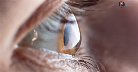 LASIK: Purpose, Benefits, Preparation, Procedure & Risks