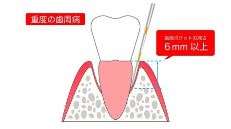 歯周ポケットは深くなっても治る？回復させる方法と進行を防ぐケア方法！｜wakanote