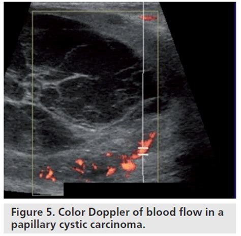 Color Doppler Sonography Characterizing Breast Lesions