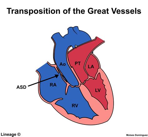 Transposition Of Great Vessels Cardiovascular Medbullets Step 2 3