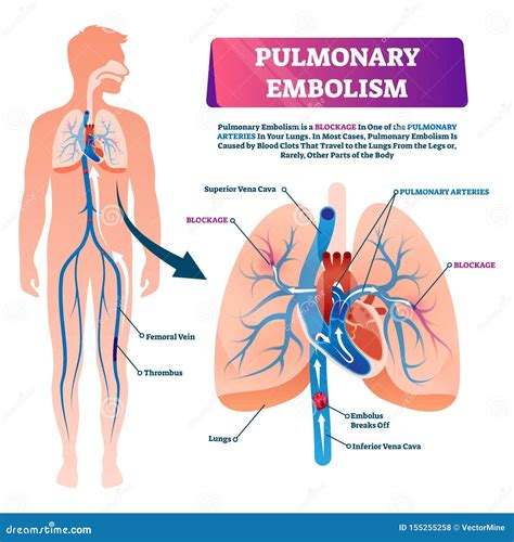 Pulmonary Embolism Vector Illustration Labeled Lung Blood Blockage