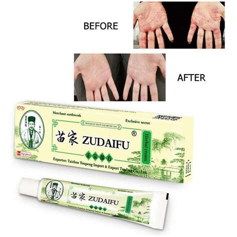 ZUDAIFU мазь от псориаза, экземы, дерматита, зуда, потницы, грибка ...