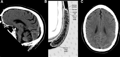 Figure 1 from An unusual vermiform giant arachnoid granulation | Semantic Scholar