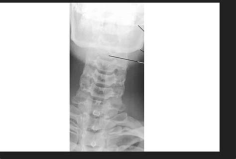 Rad Anatomy 2 Spine Review Kahoot Flashcards Quizlet