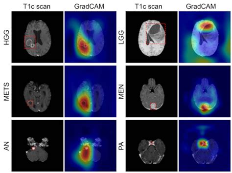 Deep Learning Classifies Brain Tumors On Single Mri Scans