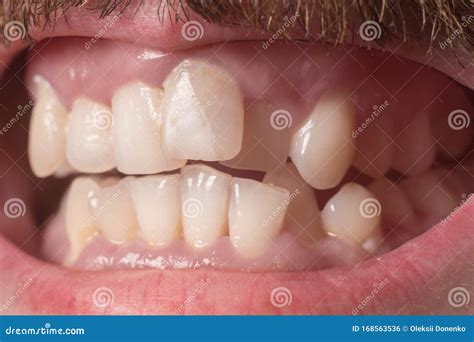 Close Up Of Very Crooked Teeth In An Adult Bearded Guy Not The Right