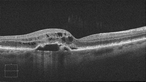 ‘wet’ macular degeneration - Applecross Eye Clinic