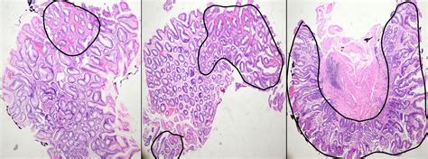 Pathology Outlines Intestinal Metaplasia