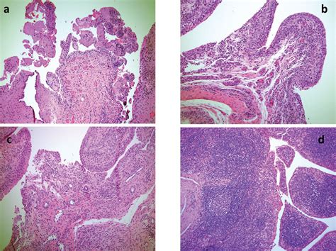 Patients With Rheumatoid Arthritis In Clinical Remission Manifest