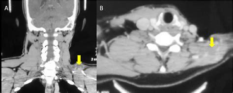 Figure 1 From Second Look Image Guided Biopsies In Inaccessible Head