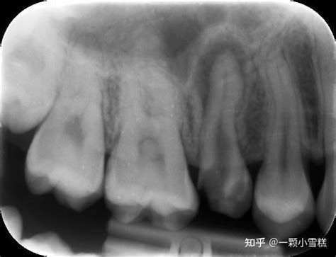 记录在英国nhs看龋齿（上牙补牙材料脱落，根管治疗） 知乎