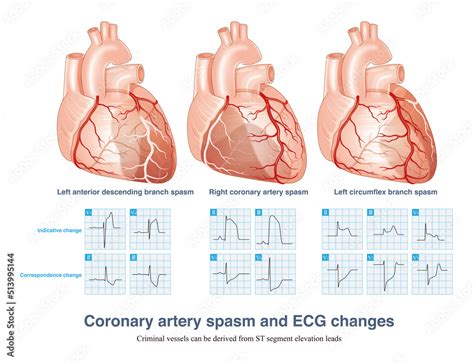 Coronary artery spasm causes transmural myocardial ischemia, and ST ...