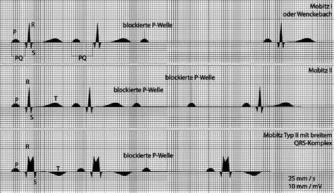 AV Blockierungen ECG