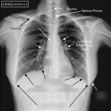 Diagram Of Chest X Ray Quizlet