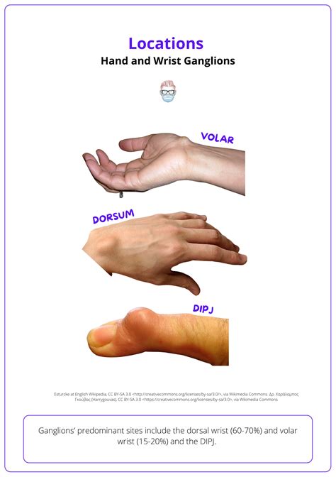 Ganglion Cysts Of The Hand And Wrist Diagnosis And Treatment