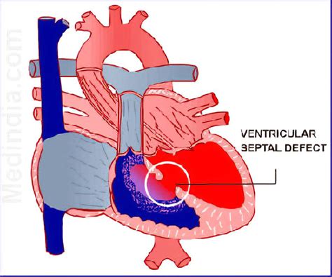 Comunicación Interventricular ventricular Septal Defect A26