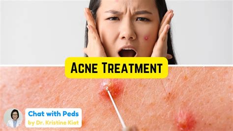 Most Effective Acne Treatment Learn From A Dermatologist Chat With