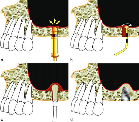 Dask Crestal Bone Planing Antrostomy Images A Surgical Drill With