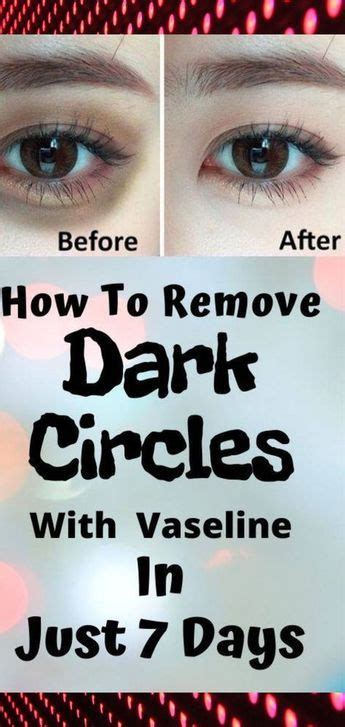 How To Remove Dark Circles Naturally In 7 Days Remove Dark Circles