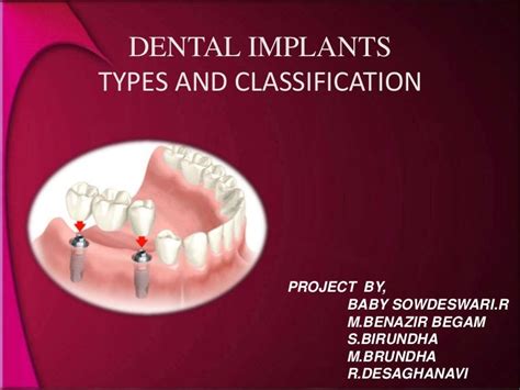 Types And Classification Of Dental Implants