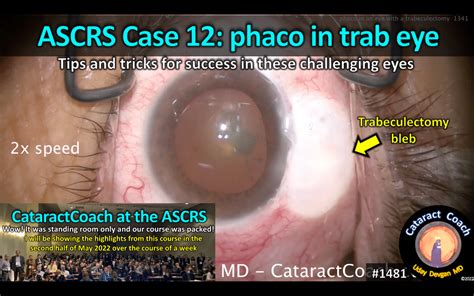 1481 Ascrs Case 12 Phaco In Trab Eyes Cataract Coach