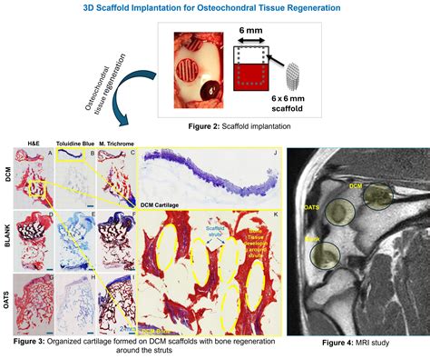 Novel Implant Promotes Osteochondral Tissue Regeneration - Research