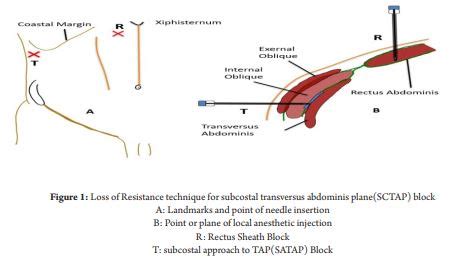 Subcostal Transversus Abdominis Plane Block Loss Of Resistance