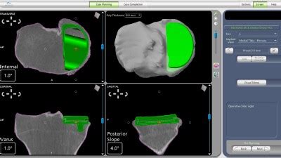 Makoplasty Singapore|Partial Knee Replacement|Faster Recovery