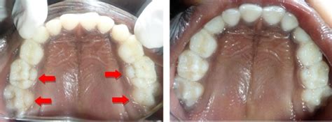 Dental Anatomic Variations In Primary Dentition A Case Series