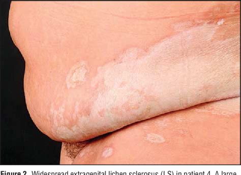 Figure 2 From Pulsed High Dose Corticosteroids Combined With Low Dose