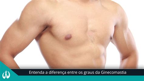 Entenda A Diferen A Entre Os Graus Da Ginecomastia Cirurgia Pl Stica Bh