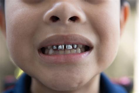 6400 Silver Teeth Stock Photos Pictures And Royalty Free Images Istock