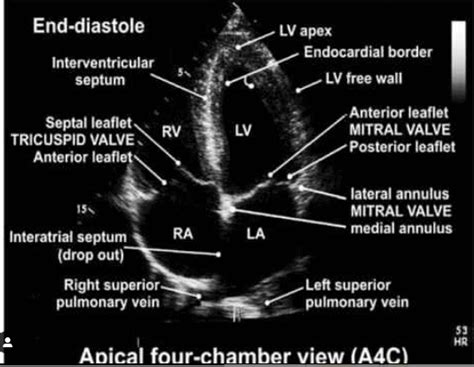 Echocardiographic Assessment Of Aortic Stenosis A Practical Guideline