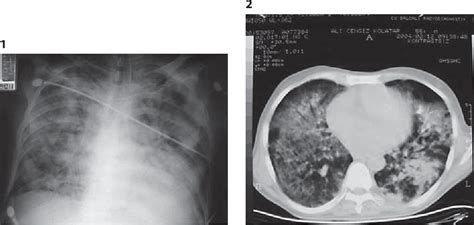 Figure 2 From Severe Pulmonary Toxicity Associated With Fludarabine And