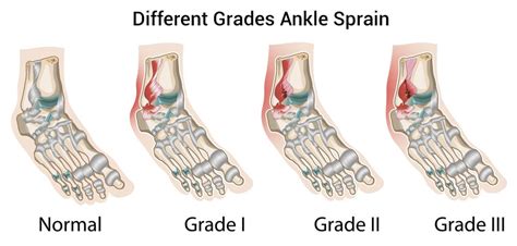 Sprained Ankle: Diagnosis, Treatment, & Recovery