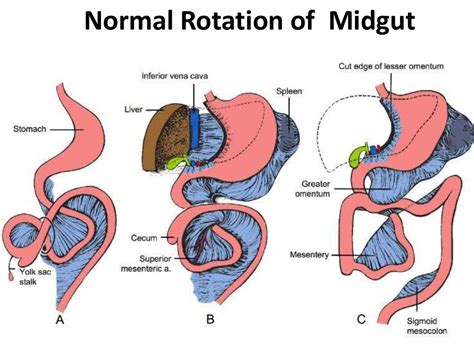 Pathopyshiology Of Intestinal Obstruction Chirantan Mandal Medical Co