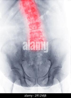 X ray showing scoliosis of the lumbar spine. Scoliosis is an abnormal lateral curvature of the ...