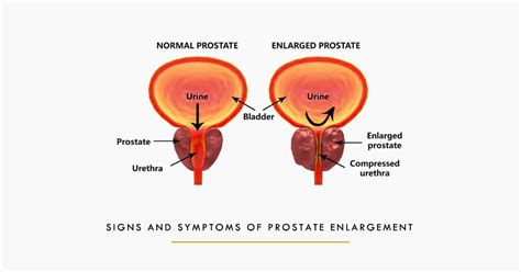 Dr. Arif Akhtar's | Signs and Symptoms of Prostate Enlargement